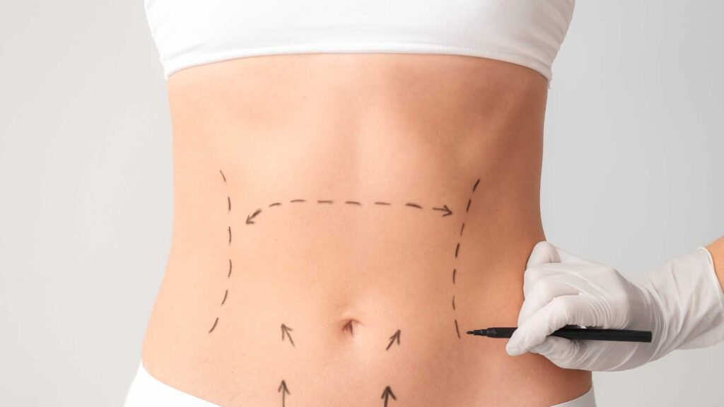 Plano de saúde cobre abdominoplastia